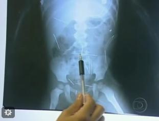 agulhas_criança_ibotirama1