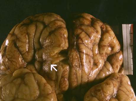 A ameba comedora de cérebros.