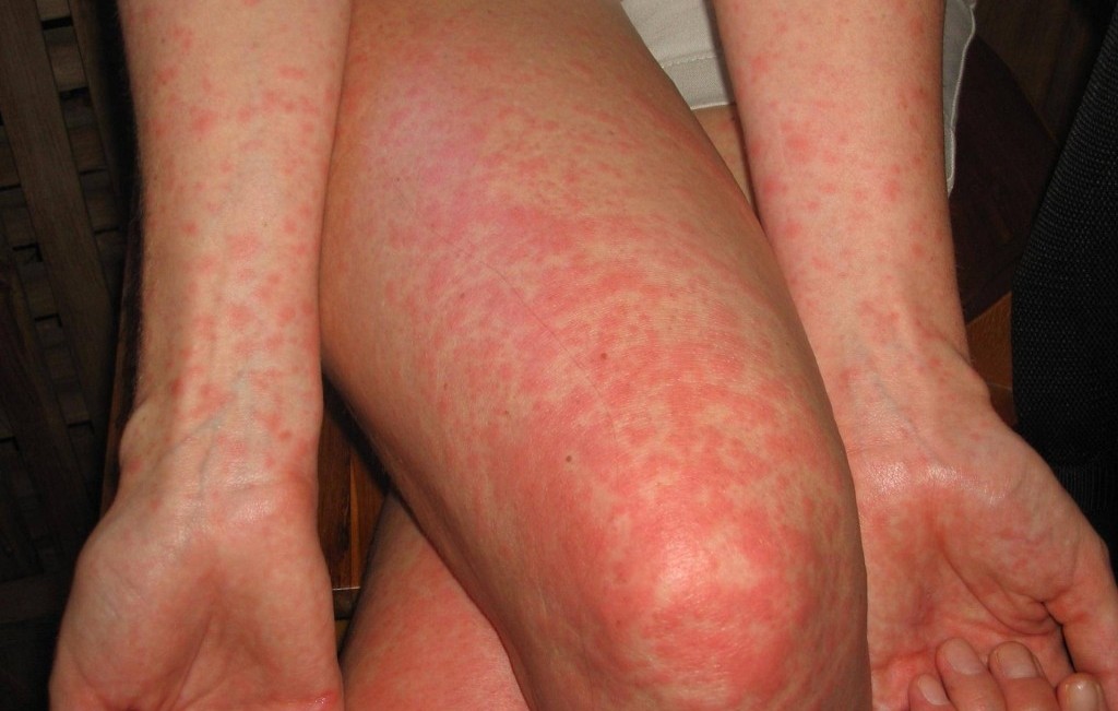 ESCABIOSE - Dermato Aula - Dermato Aula